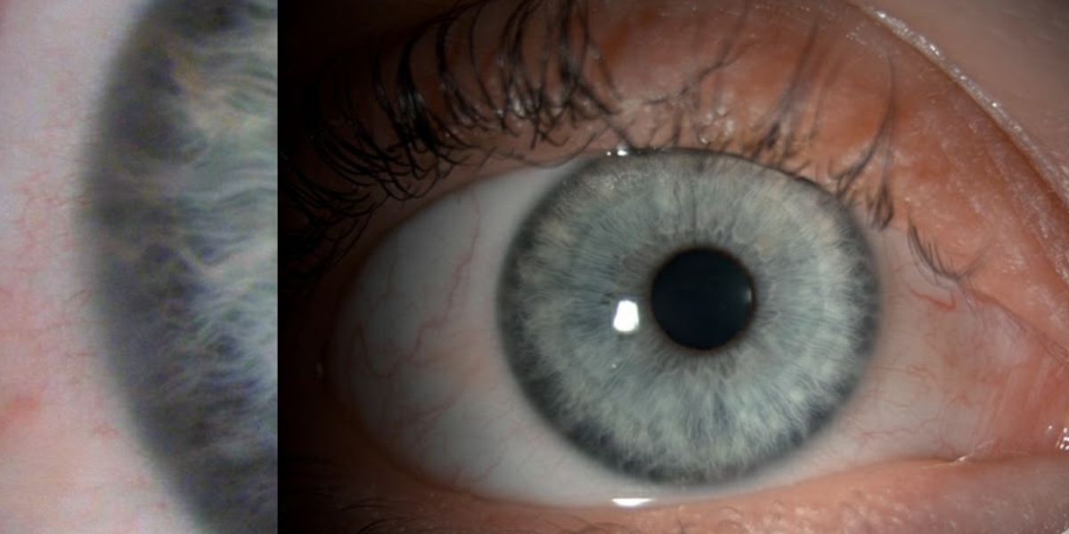Cornea Services